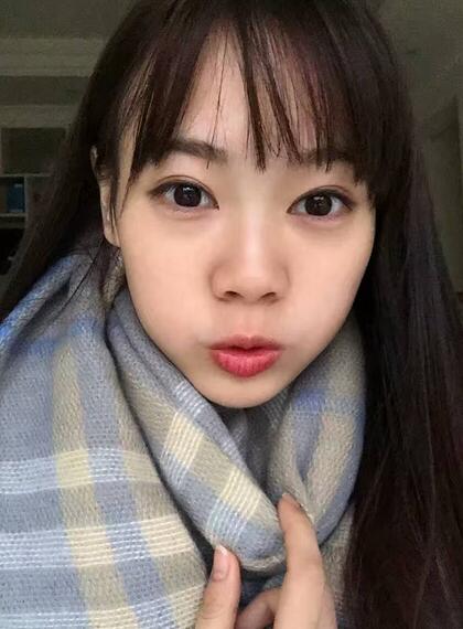 深圳晨曦三点定位双眼皮日记