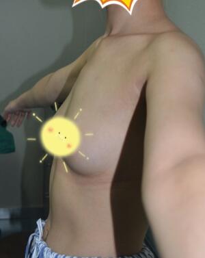 自体脂肪丰胸对比图 抽脂隆胸十天