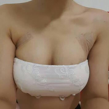 自体脂肪丰胸对比图 抽脂隆胸十天