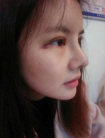 假体隆鼻两个月后的感觉 隆鼻整形手术恢复日记
