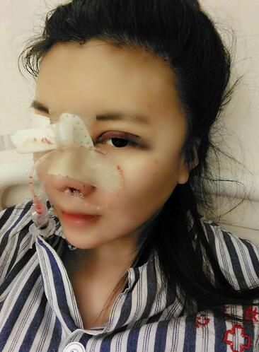 假体隆鼻两个月后的感觉 隆鼻整形手术恢复日记