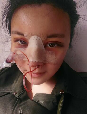 假体隆鼻两个月后的感觉 隆鼻整形手术恢复日记