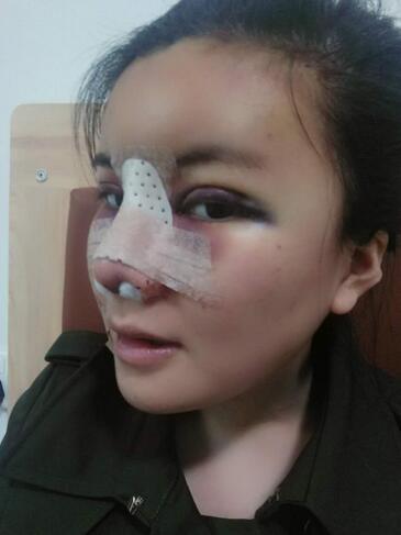 假体隆鼻两个月后的感觉 隆鼻整形手术恢复日记