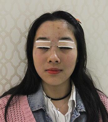 开眼角加双眼皮15天恢复图