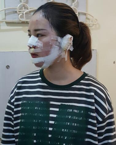 假体垫下巴一个月 前后对比