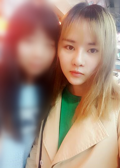 假体垫下巴一个月 前后对比