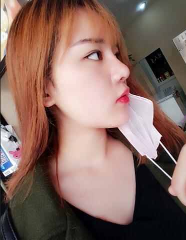 假体垫下巴一个月 前后对比