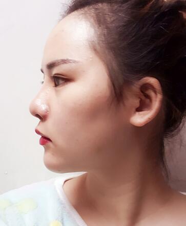 假体垫下巴一个月 前后对比