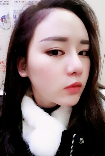 假体垫下巴一个月 前后对比