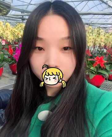 全切双眼皮1个月过程图