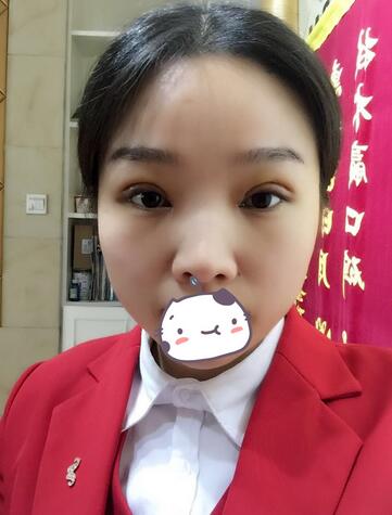 全切双眼皮1个月过程图