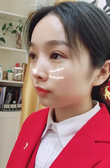全切双眼皮1个月过程图