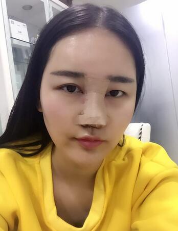 假体隆鼻+耳软骨垫鼻尖 隆鼻整形恢复图
