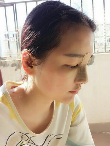 假体隆鼻+耳软骨垫鼻尖 隆鼻整形恢复图