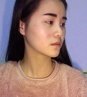 隆鼻整形3个月恢复日记