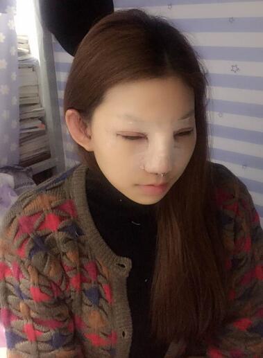 双眼皮多项整形+隆鼻整形2个月恢复之路