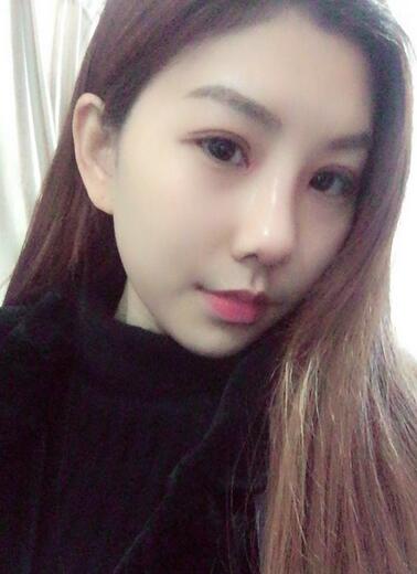 双眼皮多项整形+隆鼻整形2个月恢复之路