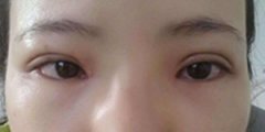 专家揭秘:800块双眼皮带给人的体验,真的是不一般! 专家揭秘:800块双眼皮带给人的体验,真的是不一般!