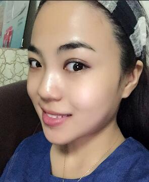 隆鼻整形恢复期照片记录 假体隆鼻+耳软骨垫鼻尖