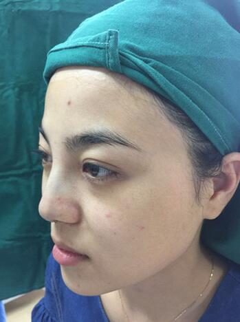 隆鼻整形恢复期照片记录 假体隆鼻+耳软骨垫鼻尖
