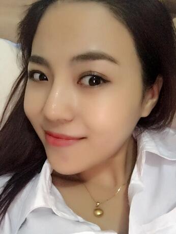 隆鼻整形恢复期照片记录 假体隆鼻+耳软骨垫鼻尖