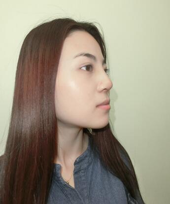 隆鼻整形恢复期照片记录 假体隆鼻+耳软骨垫鼻尖