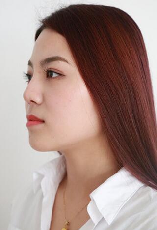 隆鼻整形恢复期照片记录 假体隆鼻+耳软骨垫鼻尖