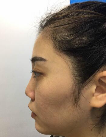 沈国雄隆鼻果 隆鼻整形恢复一个月