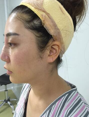 沈国雄隆鼻果 隆鼻整形恢复一个月