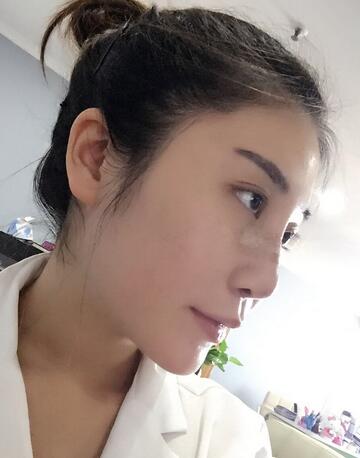 沈国雄隆鼻果 隆鼻整形恢复一个月