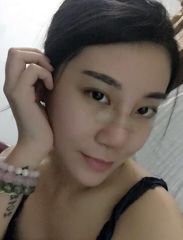 沈国雄隆鼻果 隆鼻整形恢复一个月