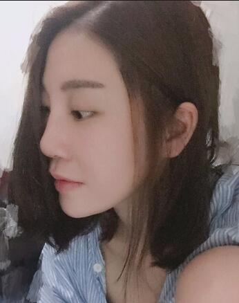 沈国雄隆鼻果 隆鼻整形恢复一个月