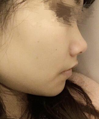 百*丽隆鼻整形恢复纪实 隆鼻+鼻头缩小+鼻小柱延长+耳软骨垫鼻尖