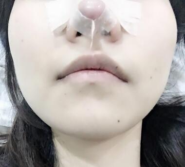 百*丽隆鼻整形恢复纪实 隆鼻+鼻头缩小+鼻小柱延长+耳软骨垫鼻尖