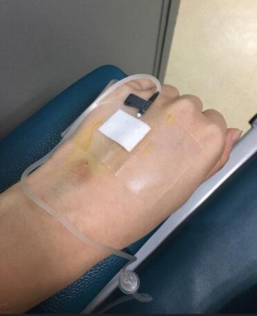 百*丽隆鼻整形恢复纪实 隆鼻+鼻头缩小+鼻小柱延长+耳软骨垫鼻尖