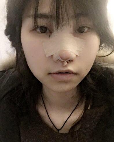 百*丽隆鼻整形恢复纪实 隆鼻+鼻头缩小+鼻小柱延长+耳软骨垫鼻尖