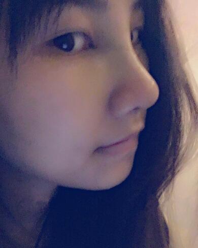 百*丽隆鼻整形恢复纪实 隆鼻+鼻头缩小+鼻小柱延长+耳软骨垫鼻尖
