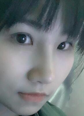 百*丽隆鼻整形恢复纪实 隆鼻+鼻头缩小+鼻小柱延长+耳软骨垫鼻尖