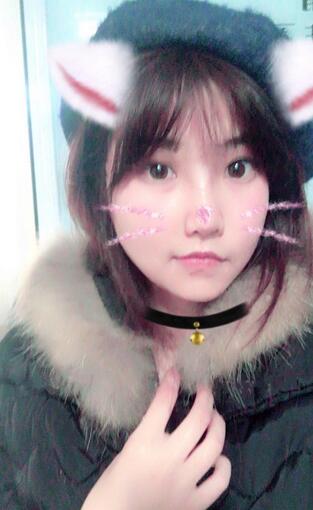 百*丽隆鼻整形恢复纪实 隆鼻+鼻头缩小+鼻小柱延长+耳软骨垫鼻尖