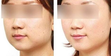 福州激光嫩肤价格、激光嫩肤一般多少钱