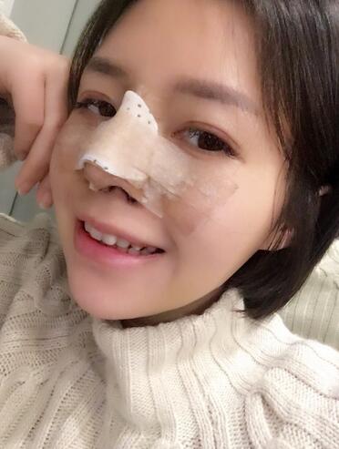 隆鼻整形多久消肿 假体隆鼻+垫鼻尖+鼻头缩小恢复日记