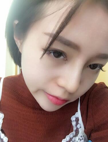 隆鼻整形多久消肿 假体隆鼻+垫鼻尖+鼻头缩小恢复日记