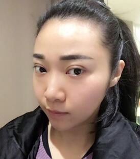隆鼻整形恢复期日记 赵博士假体垫鼻子+软骨垫鼻尖