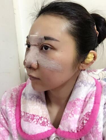 隆鼻整形恢复期日记 赵博士假体垫鼻子+软骨垫鼻尖