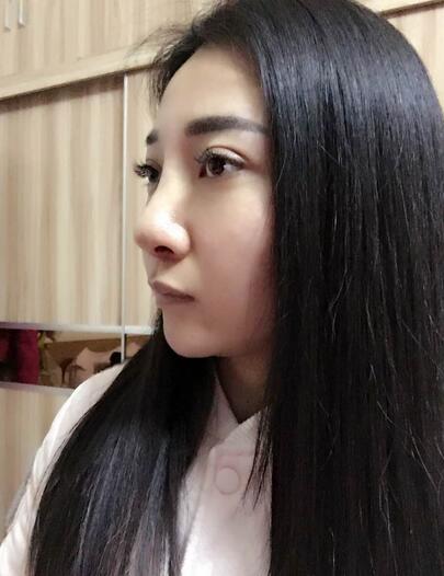 隆鼻整形恢复期日记 赵博士假体垫鼻子+软骨垫鼻尖