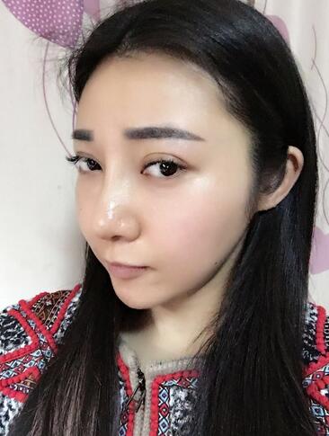 隆鼻整形恢复期日记 赵博士假体垫鼻子+软骨垫鼻尖