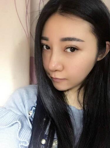 隆鼻整形恢复期日记 赵博士假体垫鼻子+软骨垫鼻尖