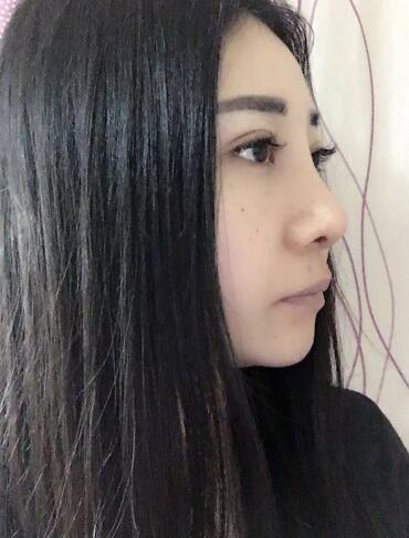 隆鼻整形恢复期日记 赵博士假体垫鼻子+软骨垫鼻尖