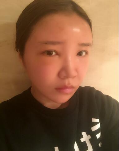 自体脂肪填充全脸1个月经历