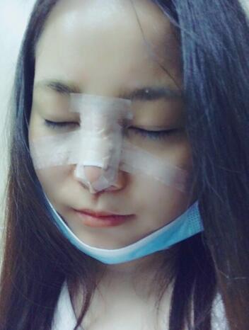 隆鼻整形日记 重庆铂生硅胶隆鼻+耳软骨鼻尖